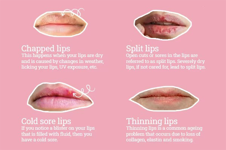 Natural ways to make your lips soft and chapped
